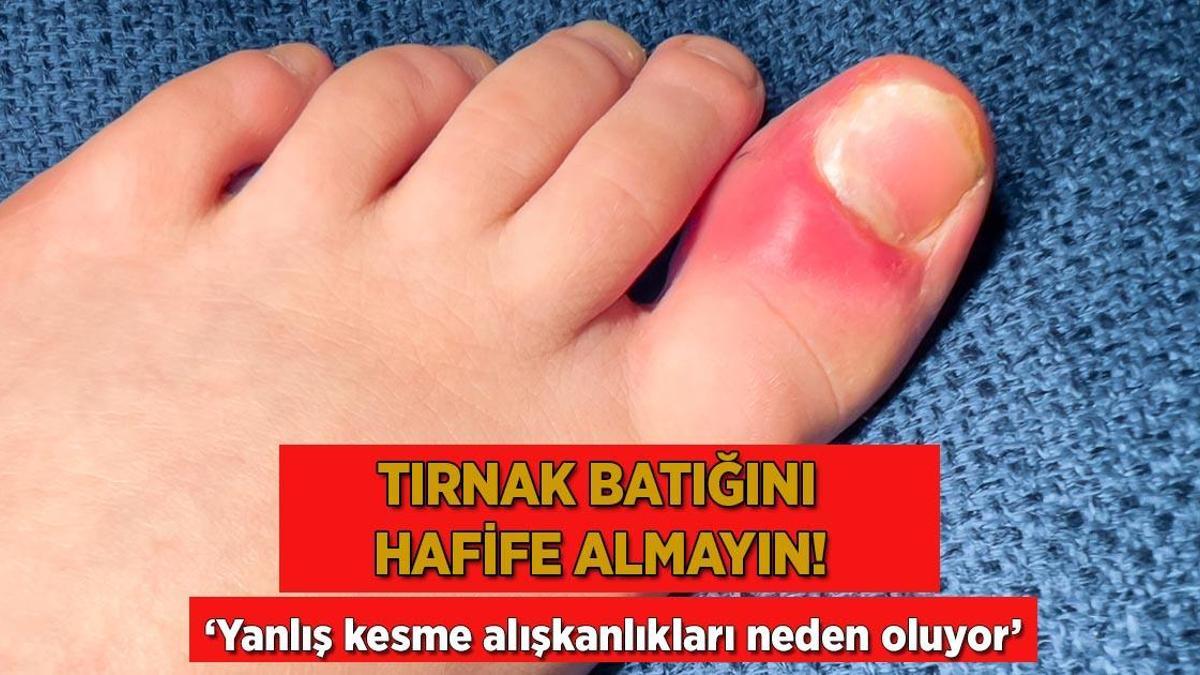 Tırnak batığını hafife almayın! ‘Yanlış kesme alışkanlıkları neden oluyor’